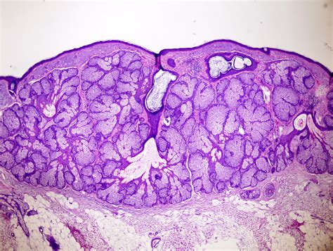 sebaceous hyperplasia pathology outlines